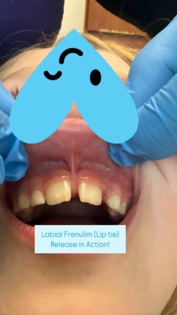 ✨ Labial Frenulum Release in Action ✨

Today’s release was extra special. We had a Rockstar patient and the opportunity to collaborate with an amazing Osteopath, Angela Houston, (and Mom!) during the procedure. It was incredible to feel the gentle “unwinding” and release through the maxilla as the tension patterns changed in real time.

We used our CO₂ light scalpel laser, which allows for a precise, minimally invasive release and great healing.

A tight or restrictive labial frenulum (lip tie) can contribute to:
• Difficulty with breastfeeding or feeding in infants
• Gaps between the front teeth
• Limited lip mobility
• Improper oral posture and muscle function
• Increased tension through the face and jaw

Releasing the frenulum allows for improved mobility, better function, and more balanced growth and development of the oral structures.

Grateful to work with wonderful patients and interdisciplinary collaboration for optimal care and function.

#functionaldentistry #labialfrenectomy #airwaydentistry #liptie