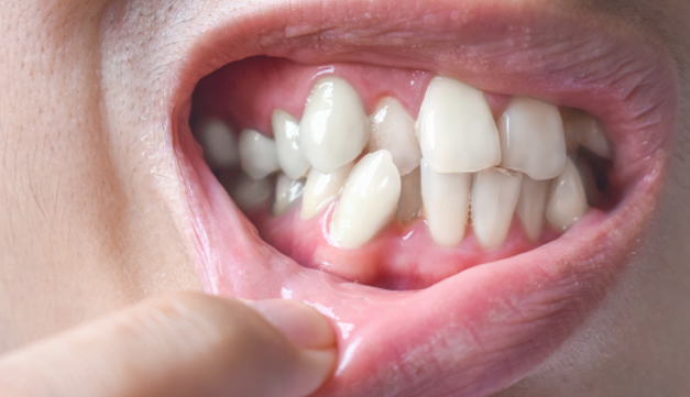Crowded-or-Crooked-Teeth