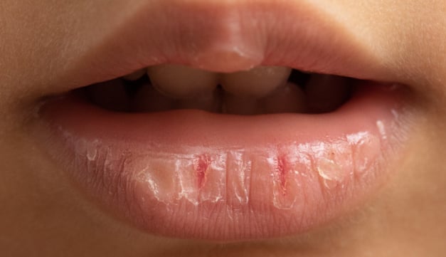 Dry-Mouth