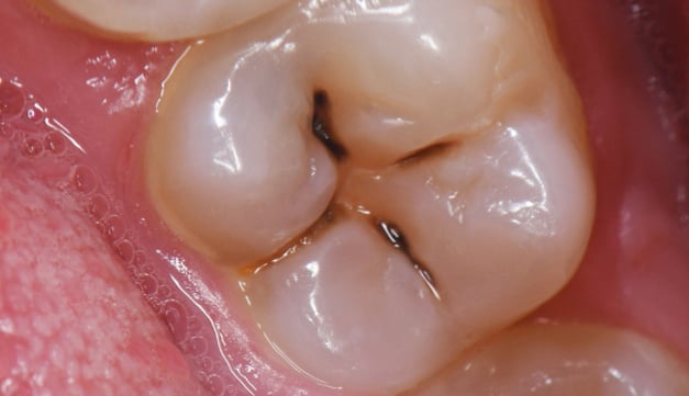Frequent-Cavities-or-Soft-Enamel